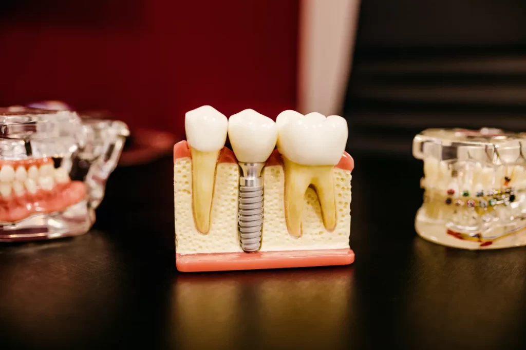 Conoce la implantología dental en Sevilla 7 Conoce la implantología dental en Sevilla